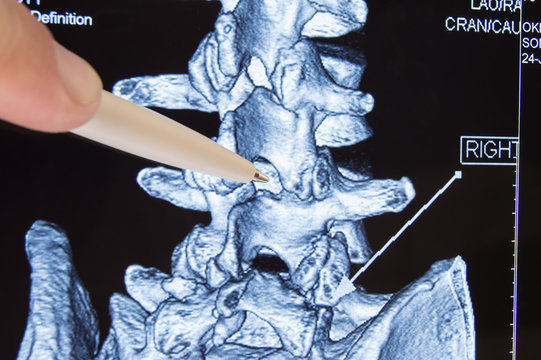 Doctor shows on CT MRI scans place in spine between vertebrae, which is procedure of epidural anesthesia or spinal puncture conduct. Epidural anesthesia during childbirth or neurosurgical operations 