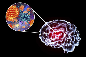 Viral encephalitis, 3D illustration showing brain and close-up view of viruses and neurons
