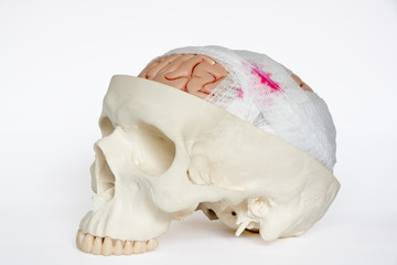 Brain injury model oblique view on the white background