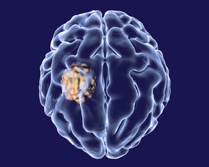 Aspergilloma of the brain, 3D illustration. Also known as mycetoma, or fungus ball, an intracranial lesion produced by fungi Aspergillus in immunocompromised patients