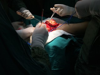 Tumor surgery of leg