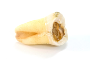 decayed tooth on white background