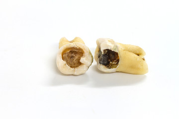decayed tooth on white background