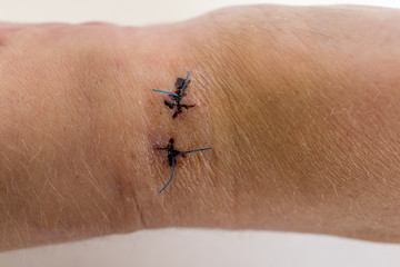 Narben am Handgelenk, Radiusfraktur