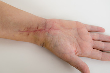 Fototapeta premium Narben am Handgelenk, Radiusfraktur