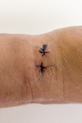 Narben am Handgelenk, Radiusfraktur