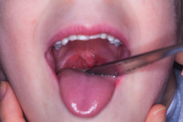 Obraz premium tonsilitis infection throat.macro opened mouth throat tonsil