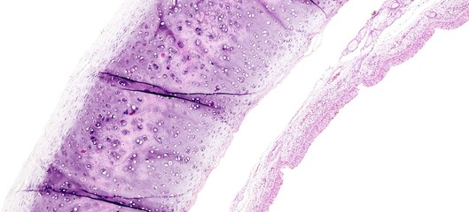 Histology of human tissue, show tracheitis as seen under the microscope