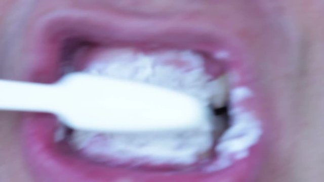 Bleeding gums in a man. Gingivitis or periodontitis
