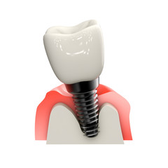 歯のインプラントと歯周病の歯茎