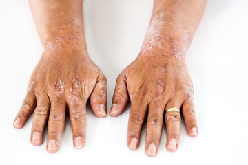 Fototapeta premium Atopic dermatitis (AD), also known as atopic eczema, is a type of inflammation of the skin (dermatitis).