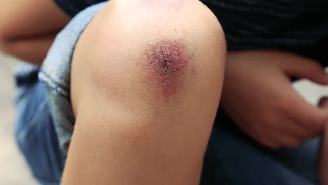 Closeup of injured young kid's knee after he fell down on pavement. Boy inspecting his wounded scraped leg. Real time full hd video footage.
