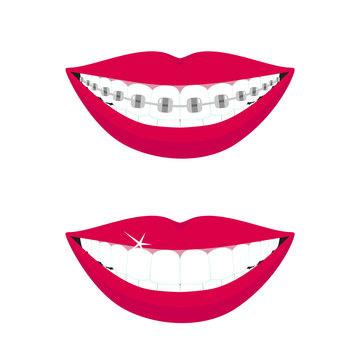 Beautiful smiling mouth with braces on teeth before and after. Design concept. Vector illustration