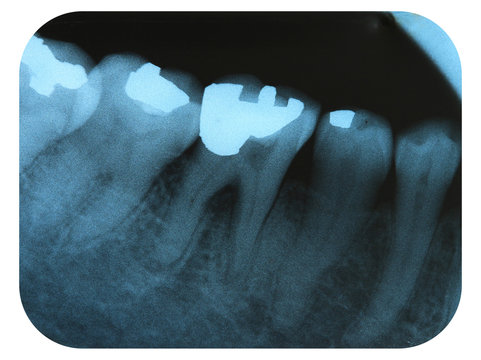 X-Ray Negative Tooth Filling Amalgam