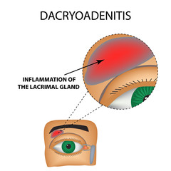 Dacryoadenitis. Inflammation of the lacrimal gland. The structure of the eye. Infographics. Vector illustration on isolated background.