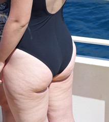 body with cellulite