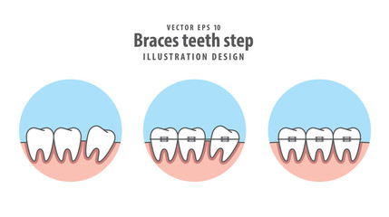 Braces teeth step in circle illustration vector on white background. Dental concept.