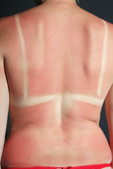 Back burnt after sunburn