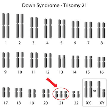 Karyotype of Down syndrome 