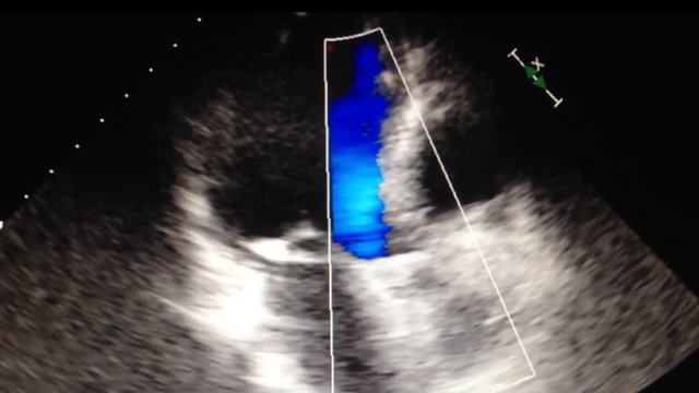 Echocardiography (ultrasound examination of the heart)