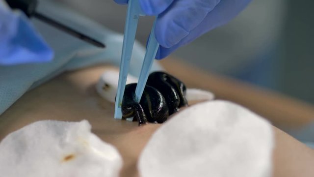 Macro view on leeches being removed from skin. 