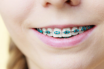 Closeup of woman teeth with braces