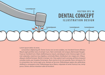 Layout decay tooth treatment (Caries) cartoon style for info or book illustration vector. Dental concept.