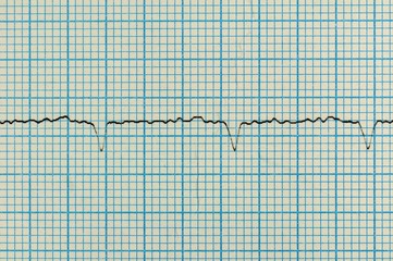 Heart analysis, electrocardiogram graph (ECG)