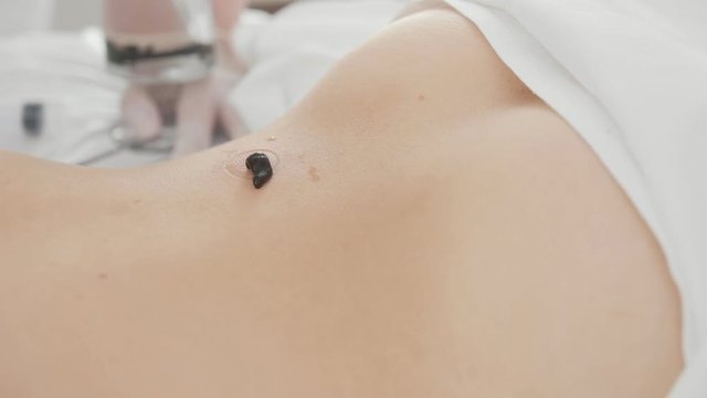 Hirudotherapy in clinic - Leech on skin of woman