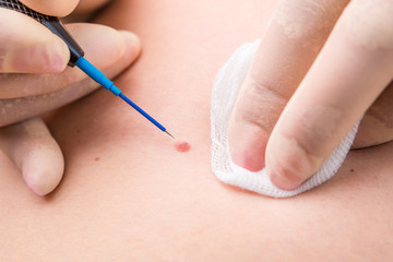 Professional medical removal of a birthmark on the back of a patient. Close-up