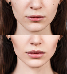Lips of young woman before and after augmentation