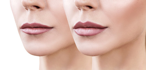 Lips of adult woman before and after augmentation - obrazy, fototapety, plakaty