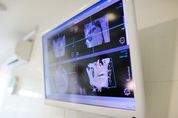 x-ray of the jaw of the patient on a large monitor