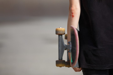 Wound on the hand of a skateboarder