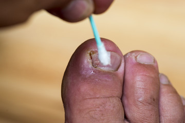 Toe disease