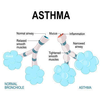 asthma. alveoli and bronchiole.