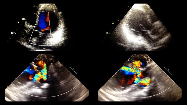 Echocardiography (ultrasound examination of the heart)