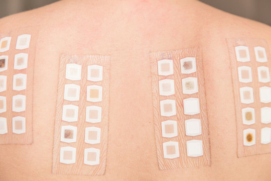 Alergy patch test on the back of a young woman