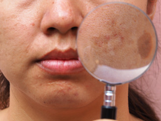Melasma on woman face close up by magnifying glass