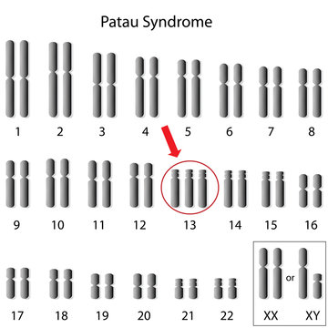 Karyotype of Patau syndrome, trisomy 13