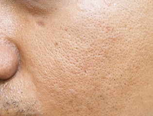 pores and oily on surface young asian man face skin do not take care for a long time