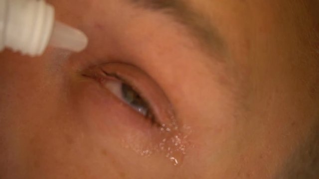 Close up of an eye of a child receiving medicine, eye drop.