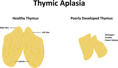 Thymic Aplasia
