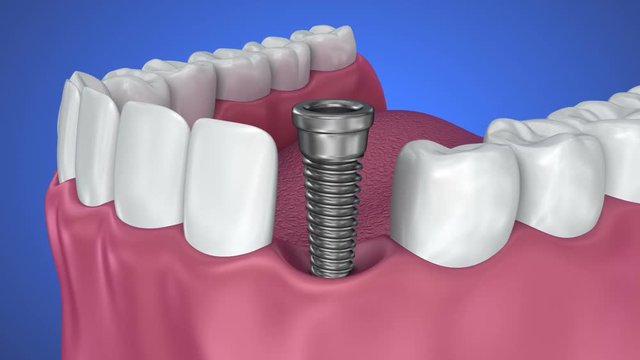 Tooth implant and crown installation process. Medically accurate 3D animation
