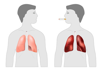 Poster about the harm of smoking. Smoker's and healthy lungs