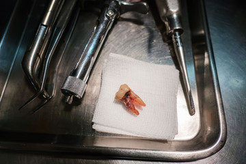 Loss of teeth from tooth extraction by the dentist. Dentistry in hospital.