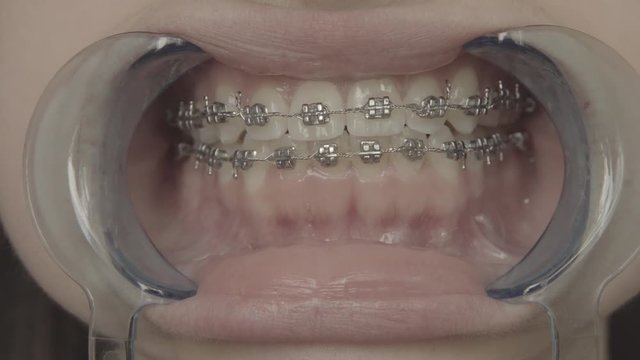 Shooting of teeth with braces wict retractor close up