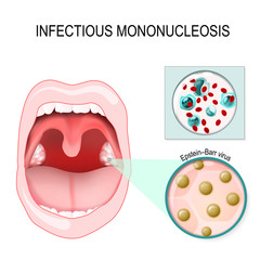 infectious mononucleosis
