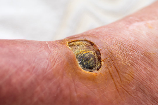 Diabetic Foot