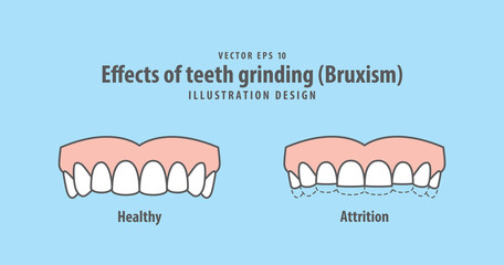 Effects of teeth grinding (Bruxism) illustration vector on blue background. Dental concept.